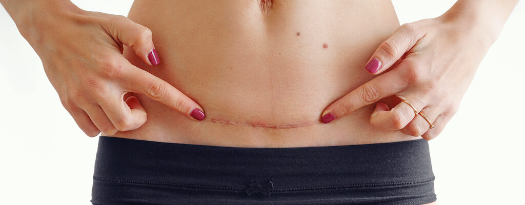 C-Section Scar Massage: How To Do It and Why You Should